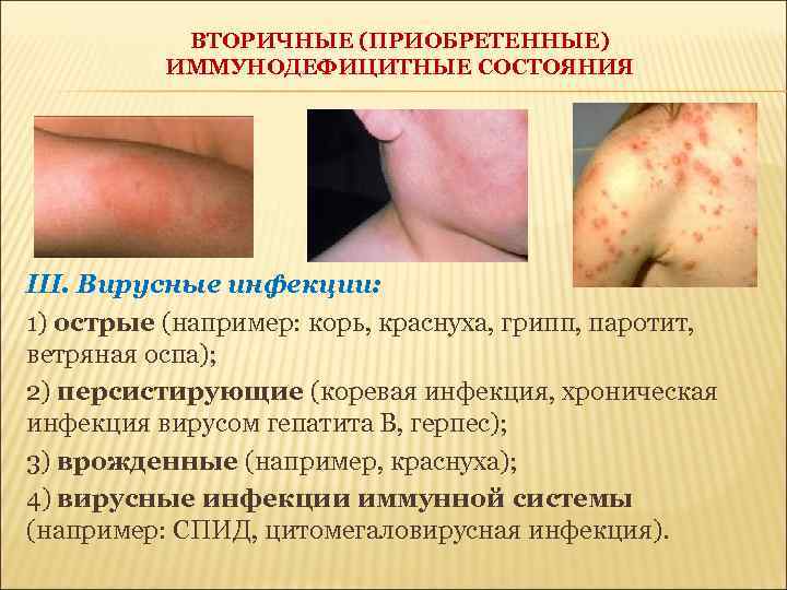 ВТОРИЧНЫЕ (ПРИОБРЕТЕННЫЕ) ИММУНОДЕФИЦИТНЫЕ СОСТОЯНИЯ III. Вирусные инфекции: 1) острые (например: корь, краснуха, грипп, паротит,