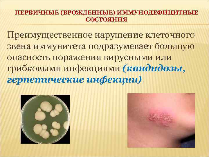 ПЕРВИЧНЫЕ (ВРОЖДЕННЫЕ) ИММУНОДЕФИЦИТНЫЕ СОСТОЯНИЯ Преимущественное нарушение клеточного звена иммунитета подразумевает большую опасность поражения вирусными