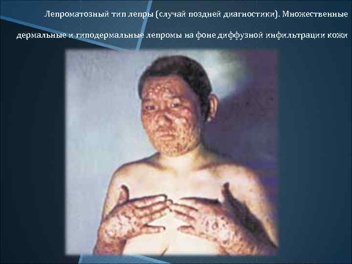 Лепроматозный тип лепры (случай поздней диагностики). Множественные дермальные и гиподермальные лепромы на фоне диффузной