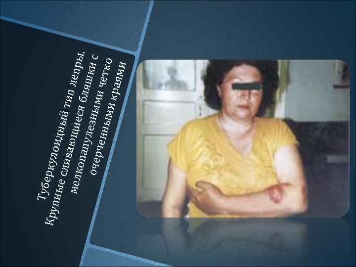 Тубе ркул Круп о идн ные ый ти с лив п ле мелк ающие