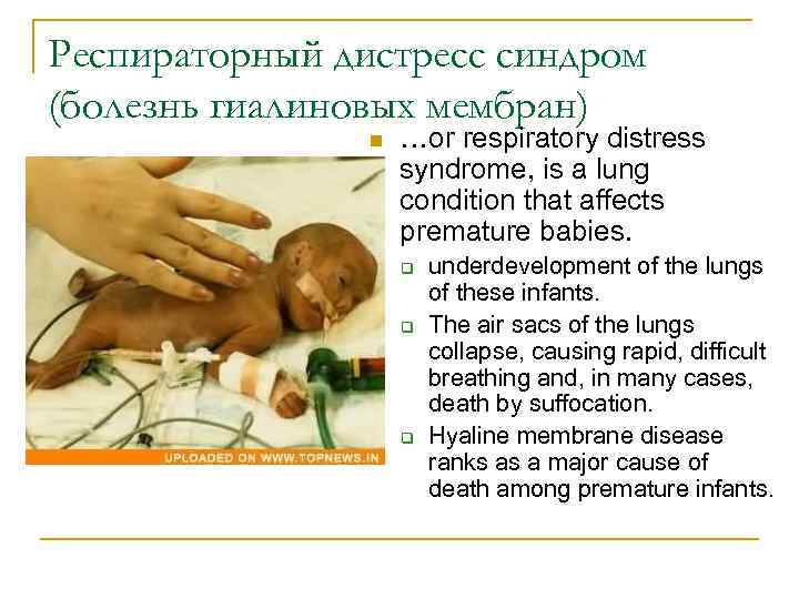 Респираторный дистресс синдром (болезнь гиалиновых мембран) n …or respiratory distress syndrome, is a lung