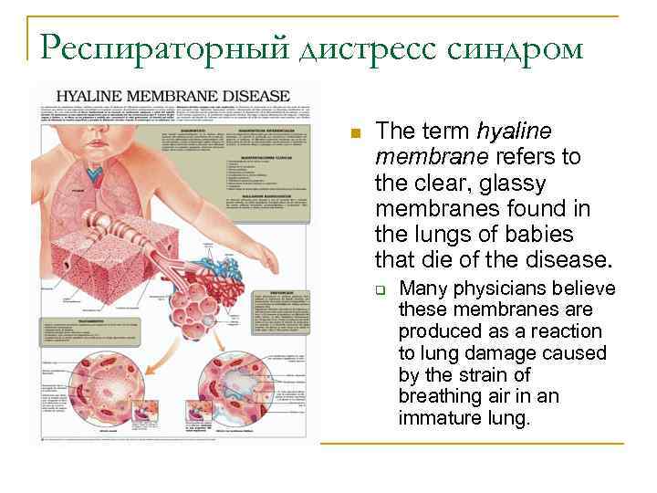 Респираторный дистресс синдром n The term hyaline membrane refers to the clear, glassy membranes