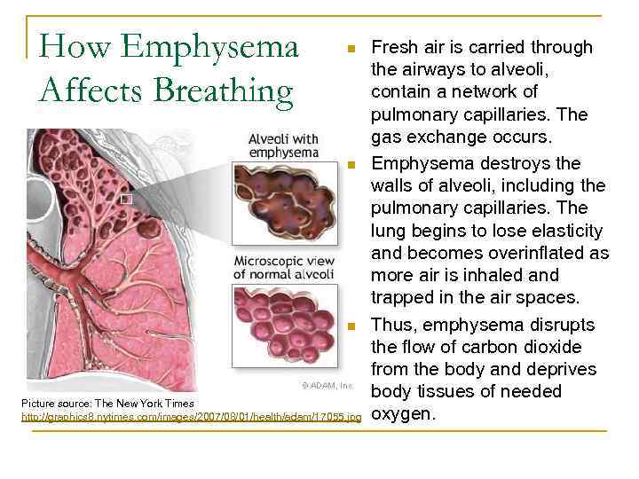 How Emphysema Affects Breathing n n n Picture source: The New York Times http: