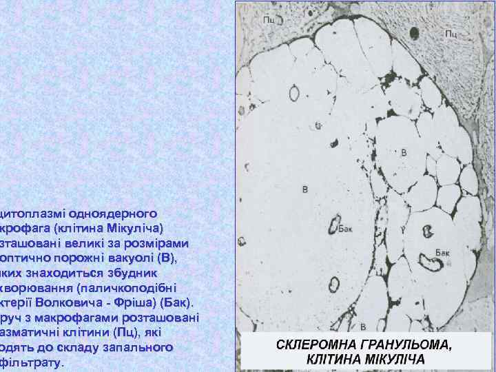 цитоплазмі одноядерного крофага (клітина Мікуліча) зташовані великі за розмірами оптично порожні вакуолі (В), яких