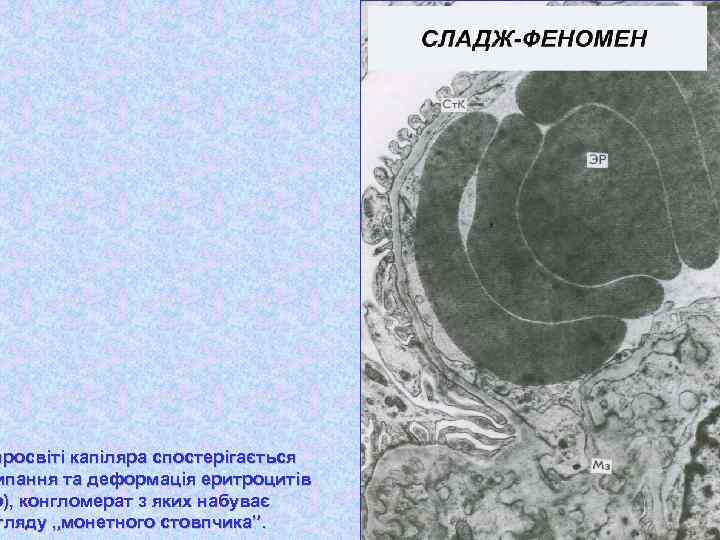 просвіті капіляра спостерігається ипання та деформація еритроцитів р), конгломерат з яких набуває гляду „монетного