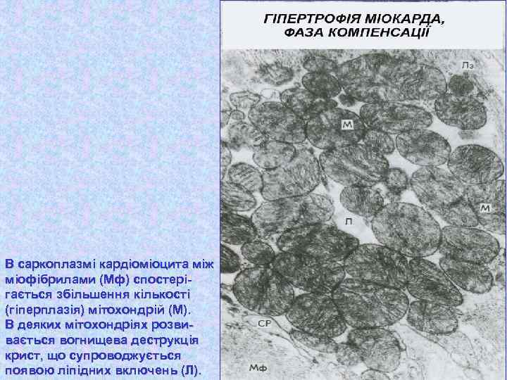 В саркоплазмі кардіоміоцита між міофібрилами (Мф) спостерігається збільшення кількості (гіперплазія) мітохондрій (М). В деяких