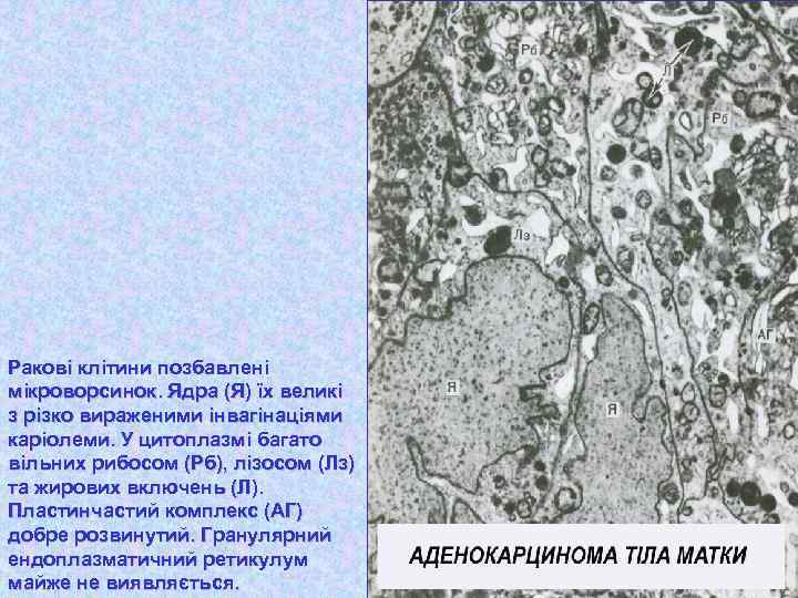 Ракові клітини позбавлені мікроворсинок. Ядра (Я) їх великі з різко вираженими інвагінаціями каріолеми. У