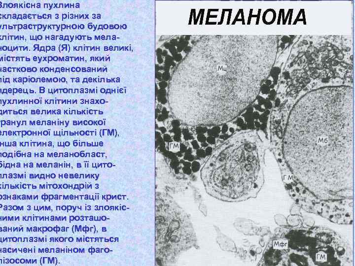 Злоякісна пухлина складається з різних за ультраструктурною будовою клітин, що нагадують меланоцити. Ядра (Я)