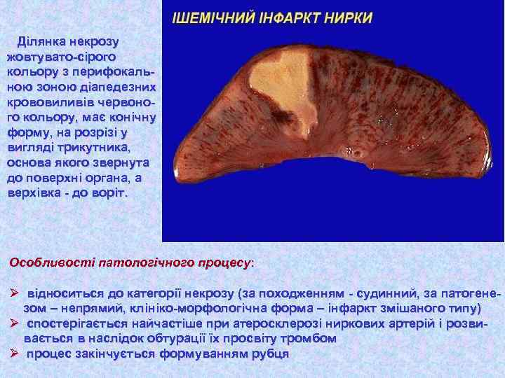 Ділянка некрозу жовтувато-сірого кольору з перифокальною зоною діапедезних крововиливів червоного кольору, має конічну форму,