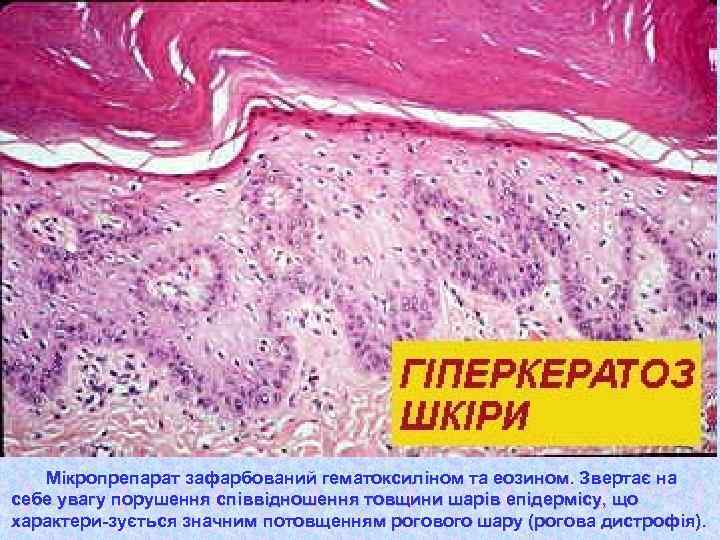 Мікропрепарат зафарбований гематоксиліном та еозином. Звертає на себе увагу порушення співвідношення товщини шарів епідермісу,