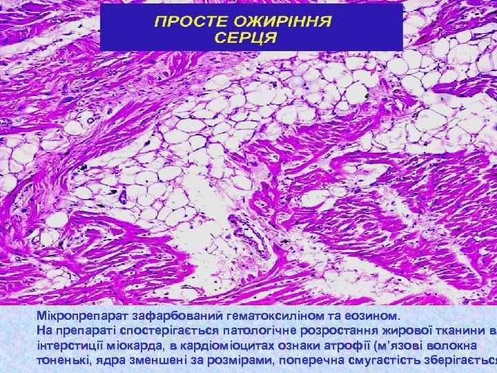 Мікропрепарат зафарбований гематоксиліном та еозином. На препараті спостерігається патологічне розростання жирової тканини в інтерстиції