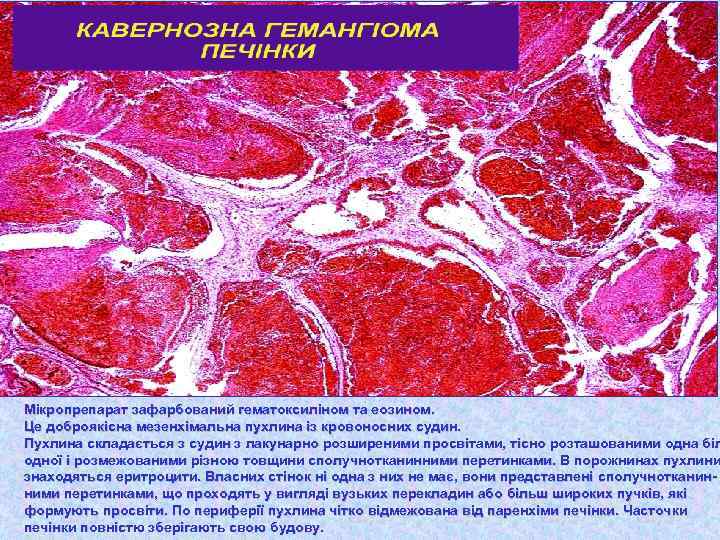 Мікропрепарат зафарбований гематоксиліном та еозином. Це доброякісна мезенхімальна пухлина із кровоносних судин. Пухлина складається