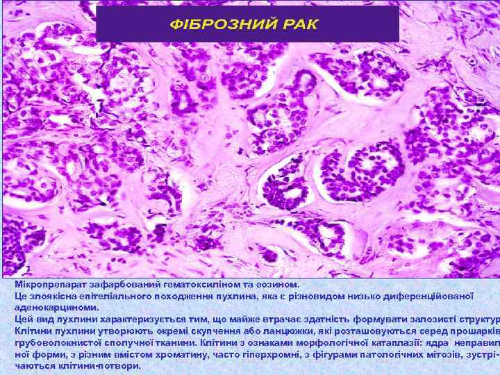 Мікропрепарат зафарбований гематоксиліном та еозином. Це злоякісна епітеліального походження пухлина, яка є різновидом низько