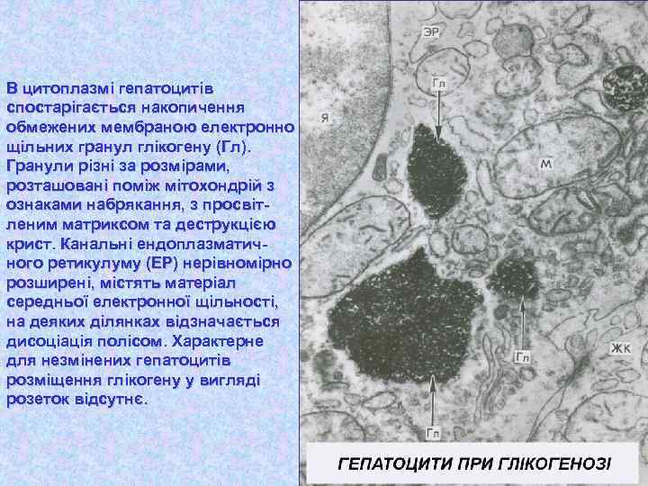 В цитоплазмі гепатоцитів спостарігається накопичення обмежених мембраною електронно щільних гранул глікогену (Гл). Гранули різні
