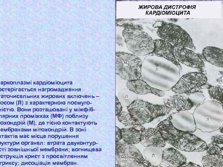 саркоплазмі кардіоміоцита остерігається нагромадження гаточисельних жирових включень – посом (Л) з характерною посмугоністю. Вони