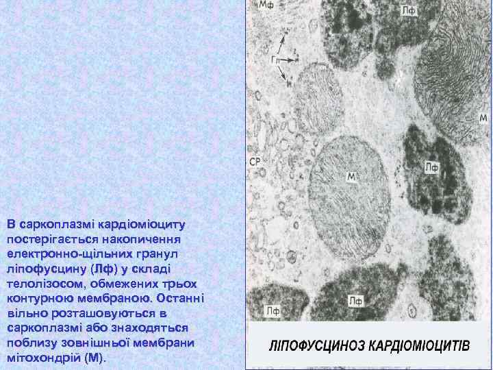 В саркоплазмі кардіоміоциту постерігається накопичення електронно-щільних гранул ліпофусцину (Лф) у складі телолізосом, обмежених трьох