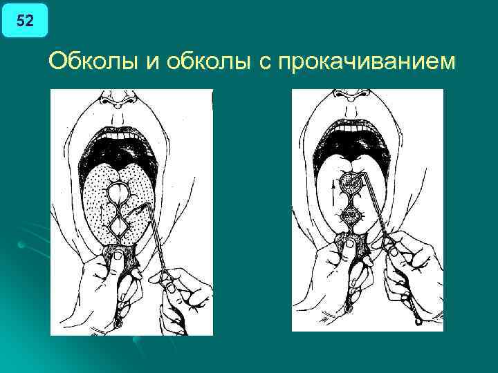 52 Обколы и обколы с прокачиванием 