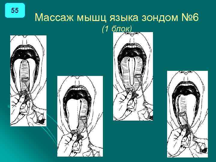 55 Массаж мышц языка зондом № 6 (1 блок) 