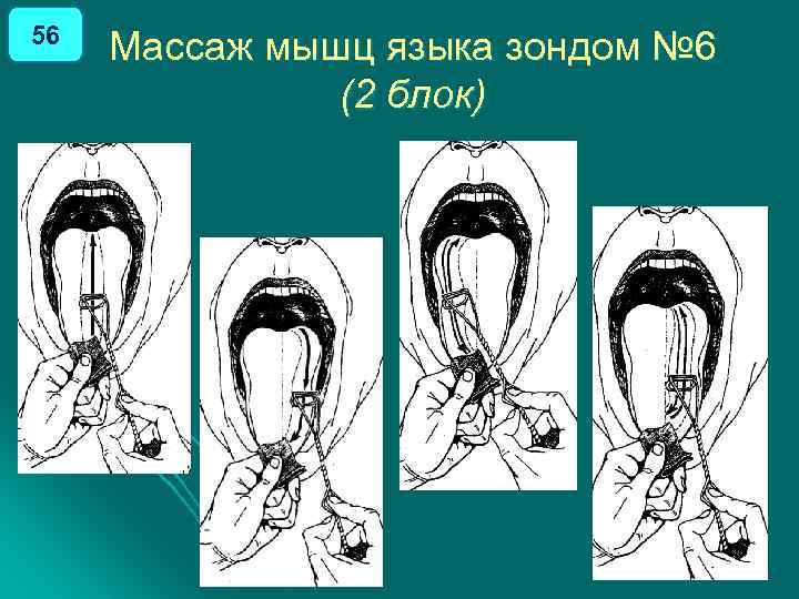 56 Массаж мышц языка зондом № 6 (2 блок) 