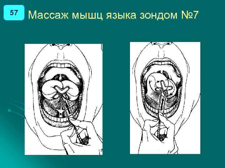 57 Массаж мышц языка зондом № 7 