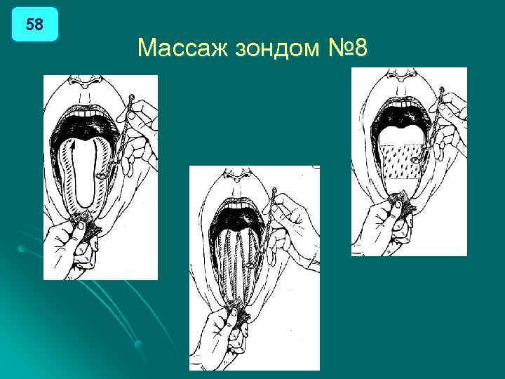 58 Массаж зондом № 8 