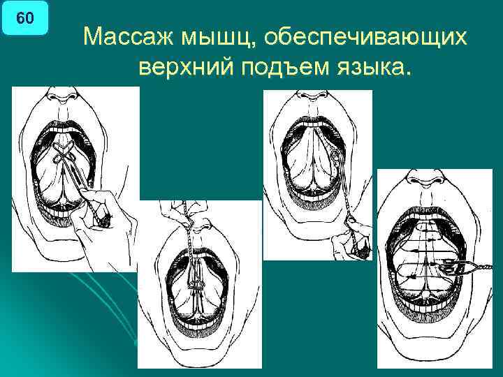 60 Массаж мышц, обеспечивающих верхний подъем языка. 