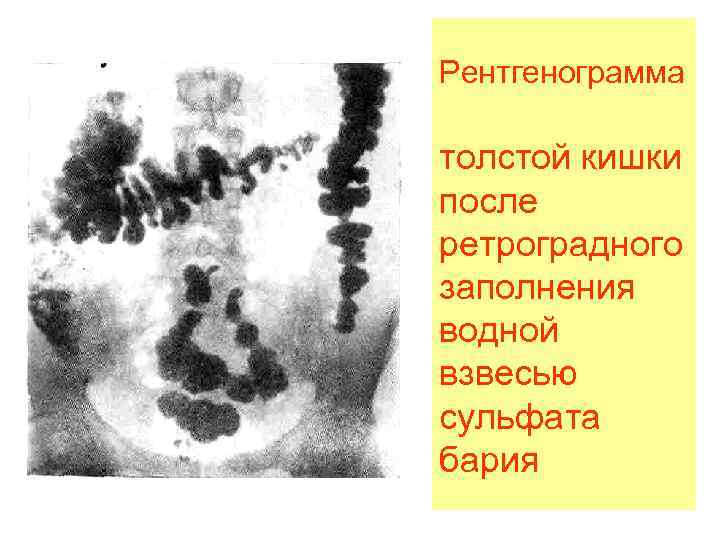 Рентгенограмма толстой кишки после ретроградного заполнения водной взвесью сульфата бария 