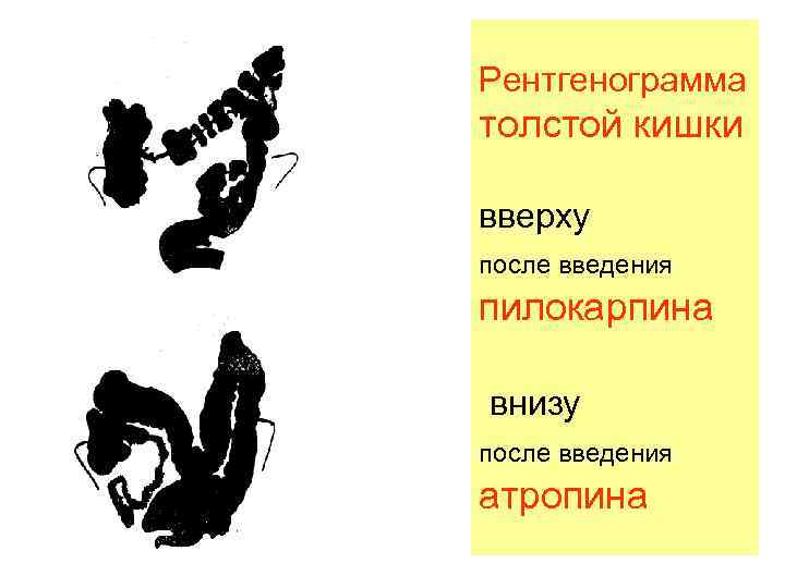 Рентгенограмма толстой кишки вверху после введения пилокарпина внизу после введения атропина 