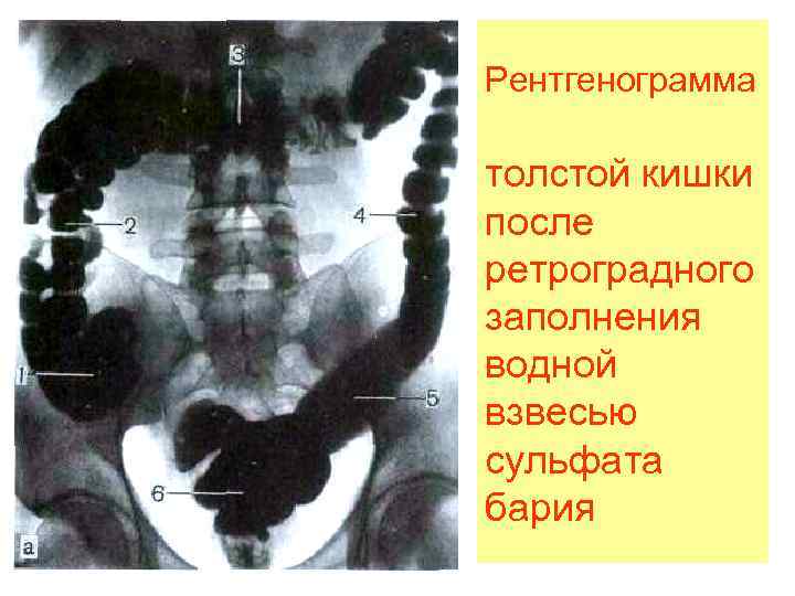 Рентгенограмма толстой кишки после ретроградного заполнения водной взвесью сульфата бария 