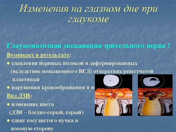 Изменения на глазном дне при глаукоме Глаукоматозная экскавация зрительного нерва ! Возникает в результате: