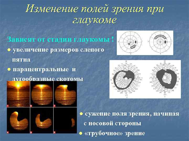 Изменение полей зрения при глаукоме Зависят от стадии глаукомы ! ● увеличение размеров слепого