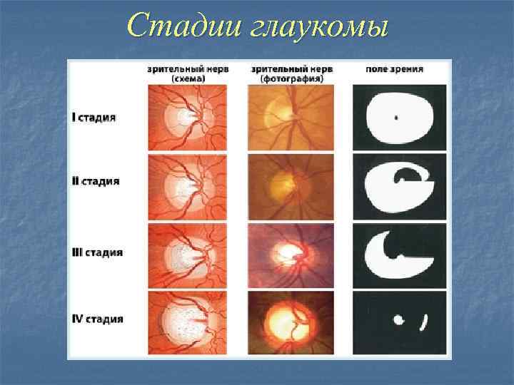 Стадии глаукомы 