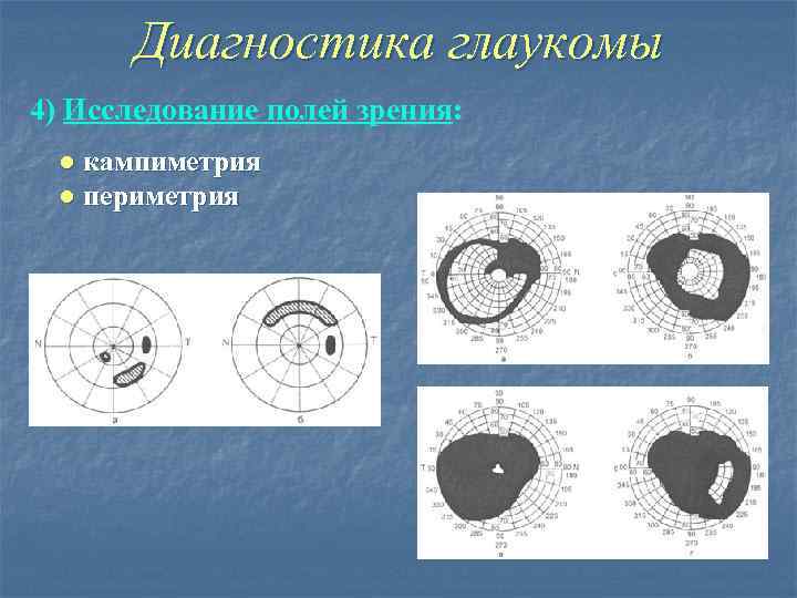Диагностика глаукомы 4) Исследование полей зрения: ● кампиметрия ● периметрия 