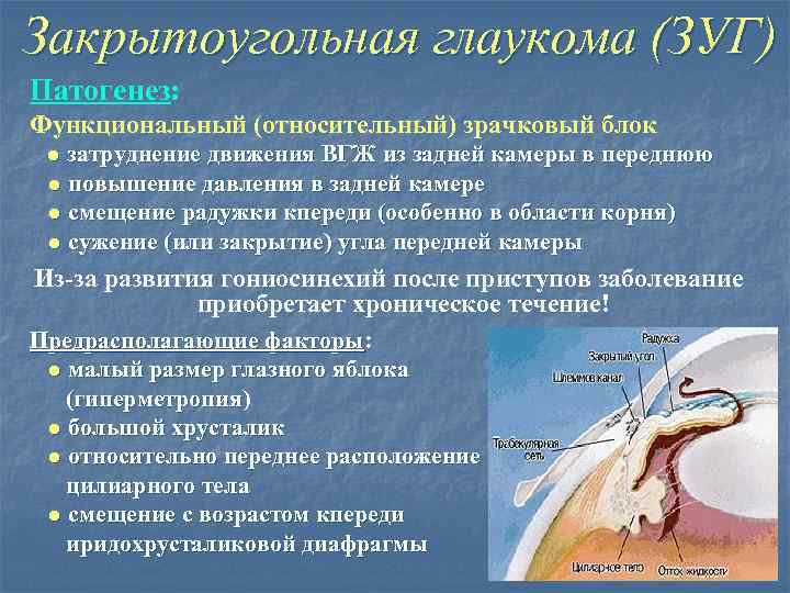 Закрытоугольная глаукома (ЗУГ) Патогенез: Функциональный (относительный) зрачковый блок ● затруднение движения ВГЖ из задней