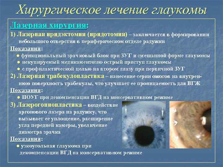 Хирургическое лечение глаукомы Лазерная хирургия: 1) Лазерная иридэктомия (иридотомия) – заключается в формировании небольшого