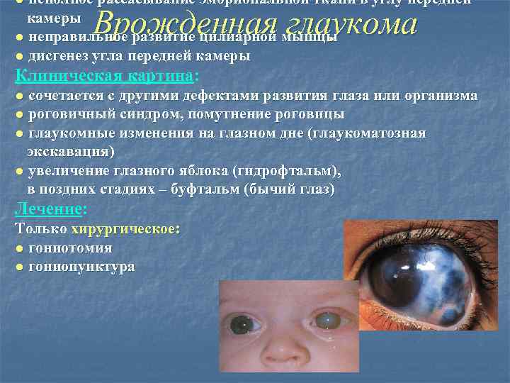● неполное рассасывание эмбриональной ткани в углу передней камеры ● неправильное развитие цилиарной мышцы