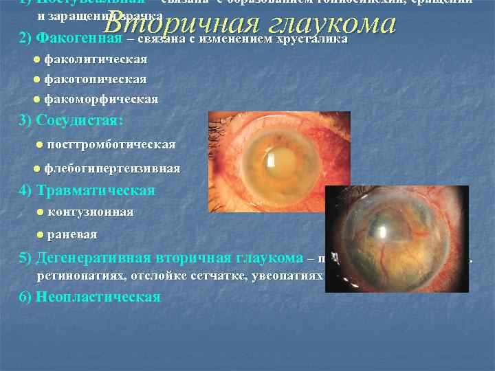 1) Постувеальная – связана с образованием гониосинехий, сращений Вторичная глаукома 2) Факогенная – связана