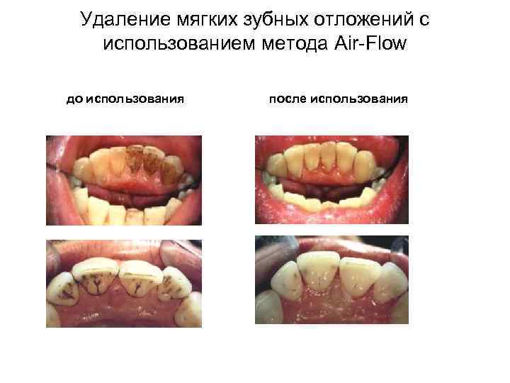 Удаление мягких зубных отложений с использованием метода Air-Flow до использования после использования 