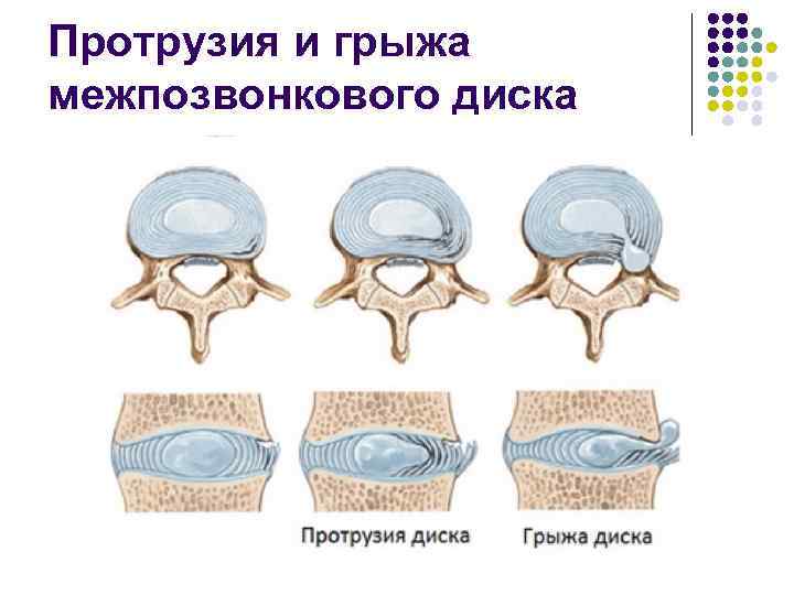 Протрузия и грыжа межпозвонкового диска 