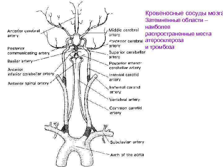 Кровеносные сосуды мозга Затемненные области – наиболее распространенные места атеросклероза и тромбоза 