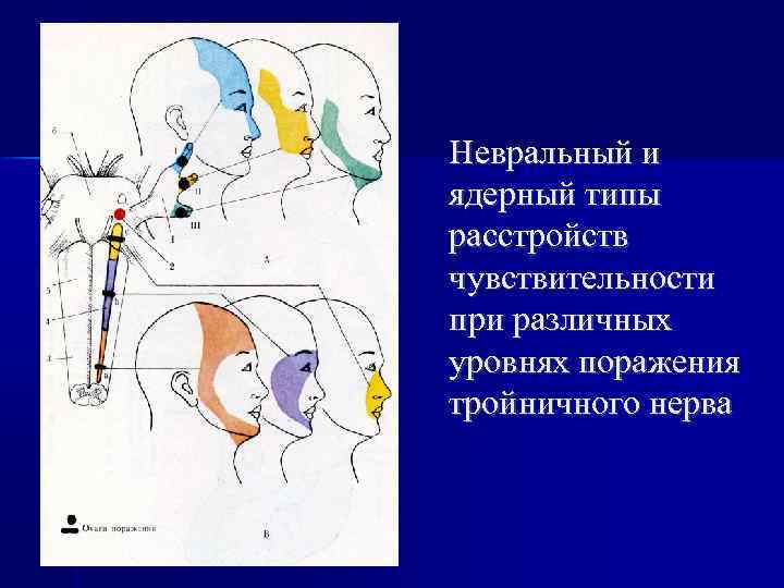Невральный и ядерный типы расстройств чувствительности при различных уровнях поражения тройничного нерва 