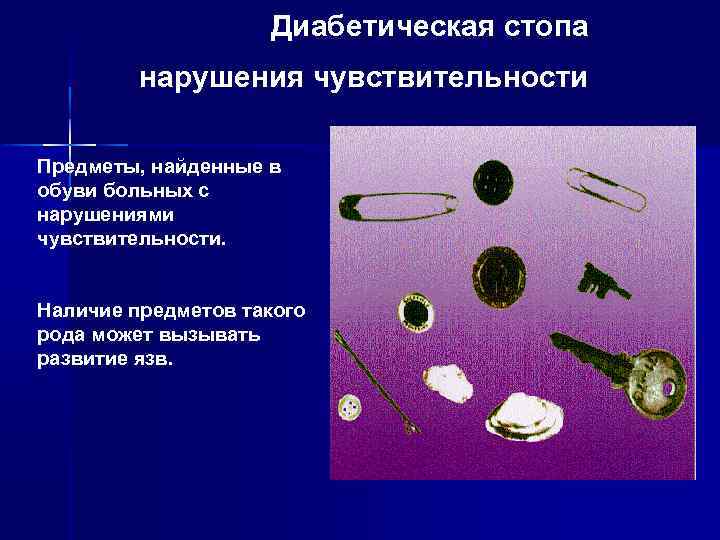 Диабетическая стопа нарушения чувствительности Предметы, найденные в обуви больных с нарушениями чувствительности. Наличие предметов