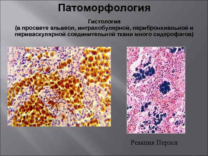 Патоморфология Гистология (в просвете альвеол, интралобулярной, перибронхиальной и периваскулярной соединительной ткани много сидерофагов) Реакция