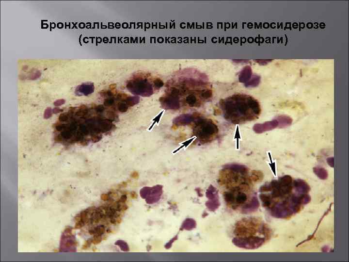 Бронхоальвеолярный смыв при гемосидерозе (стрелками показаны сидерофаги) 