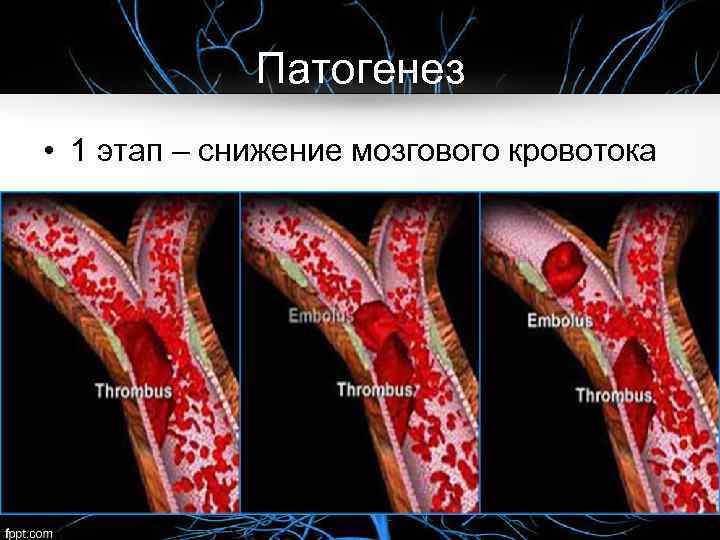 Патогенез • 1 этап – снижение мозгового кровотока 