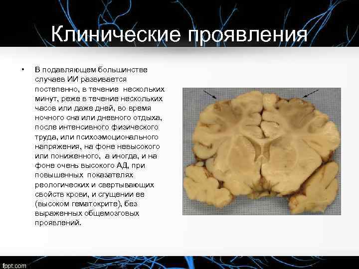 Клинические проявления • В подавляющем большинстве случаев ИИ развивается постепенно, в течение нескольких минут,