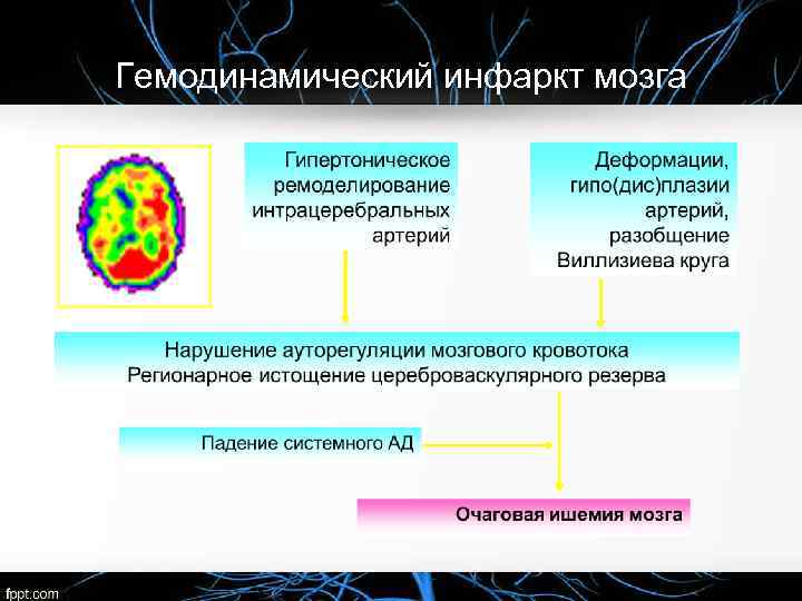 Гемодинамический инфаркт мозга 