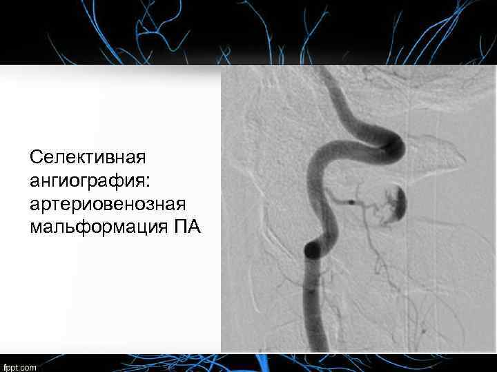 Селективная ангиография: артериовенозная мальформация ПА 