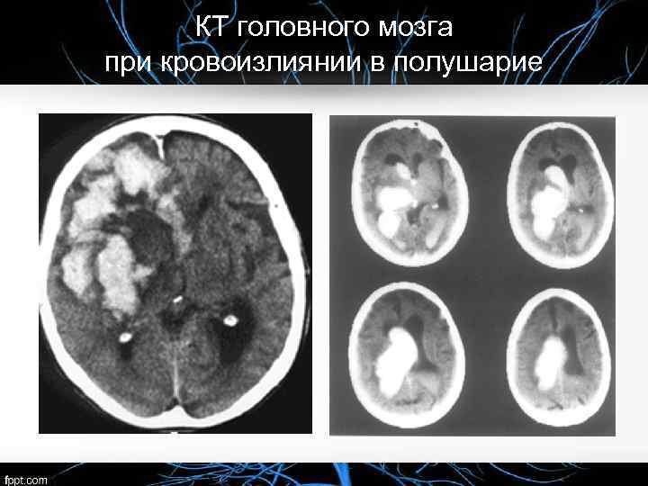 КТ головного мозга при кровоизлиянии в полушарие 