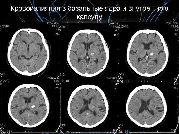 Кровоизлияния в базальные ядра и внутреннюю капсулу 